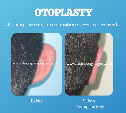 Slider image (5) Dr. Siripong Plastic Surgery in Thailand